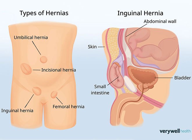 hernia-wallpaper